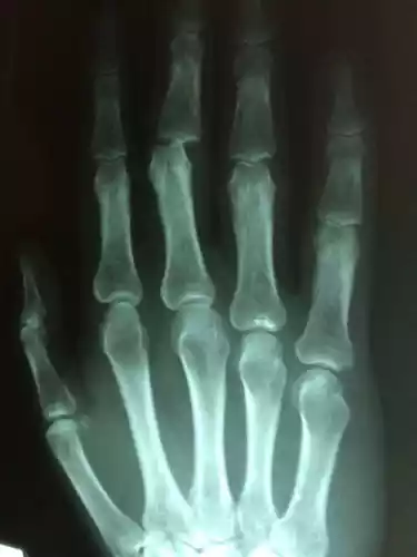 XRAY